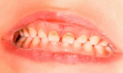 Начальный кариес молочных зубов