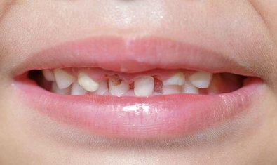 Поверхностный кариес молочных зубов