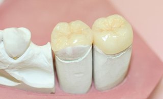 Керамические вкладки как лучший способ реставрации зубов